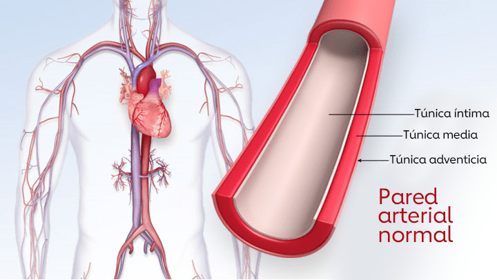 Una ilustración de la arteriosclerosis