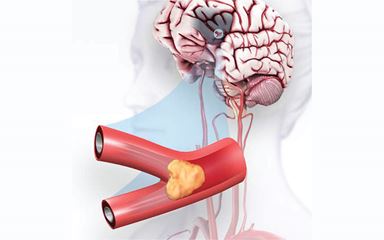 Illustration of a brain blockage