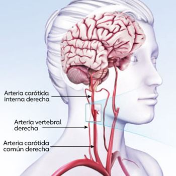 ilustración de una persona traslúcida que muestra el cerebro, la arteria carótida interna derecha, la arteria vertebral derecha y la arteria carótida común derecha ilustración de una persona traslúcida que muestra el cerebro, la arteria carótida interna derecha, la arteria vertebral derecha y la arteria carótida común derecha